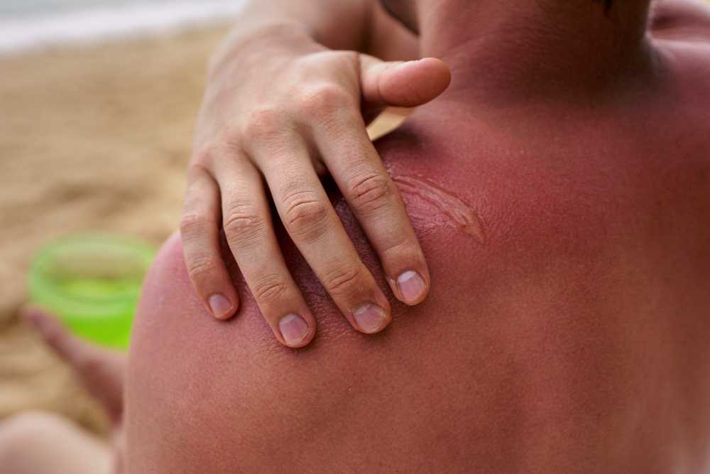 metode menghindari sunburn