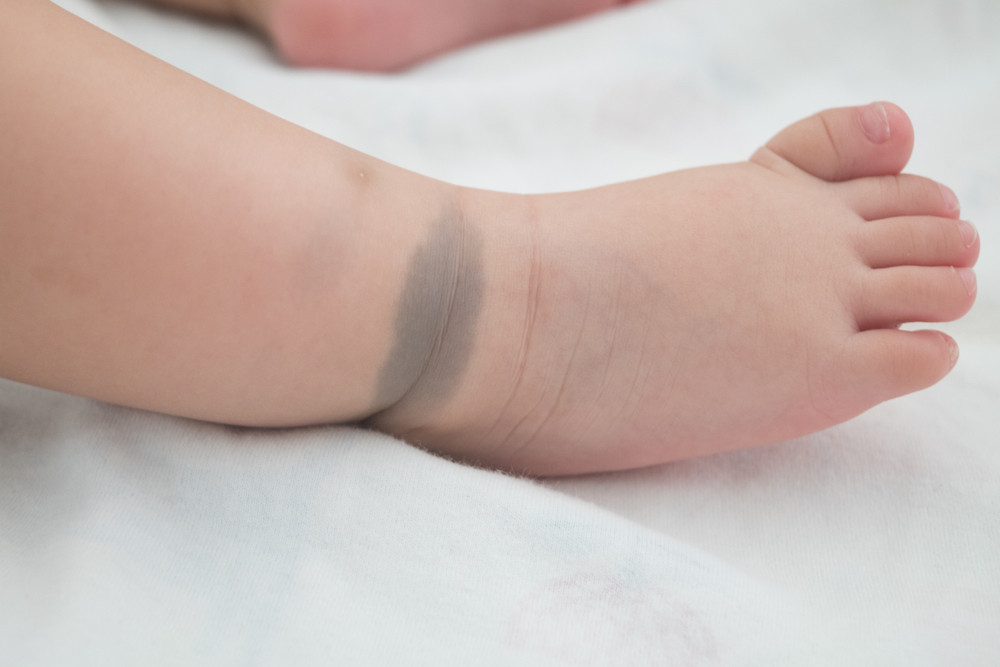 birthmark
